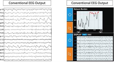 Implementation and impact of a point of care electroencephalography platform in a community hospital: a cohort study